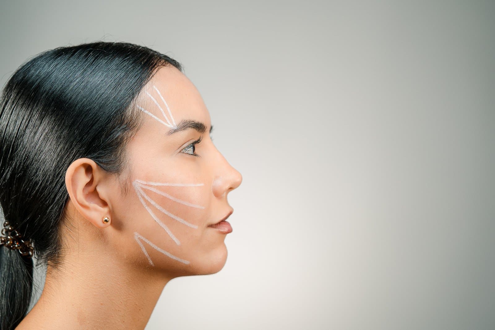 Patient profile with thread lift vectors drawn on