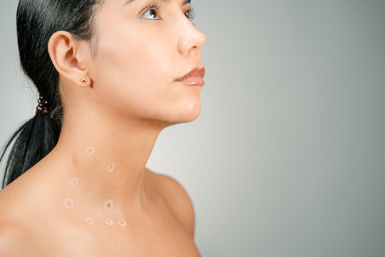Patient's neck with lesions marked for cauterization