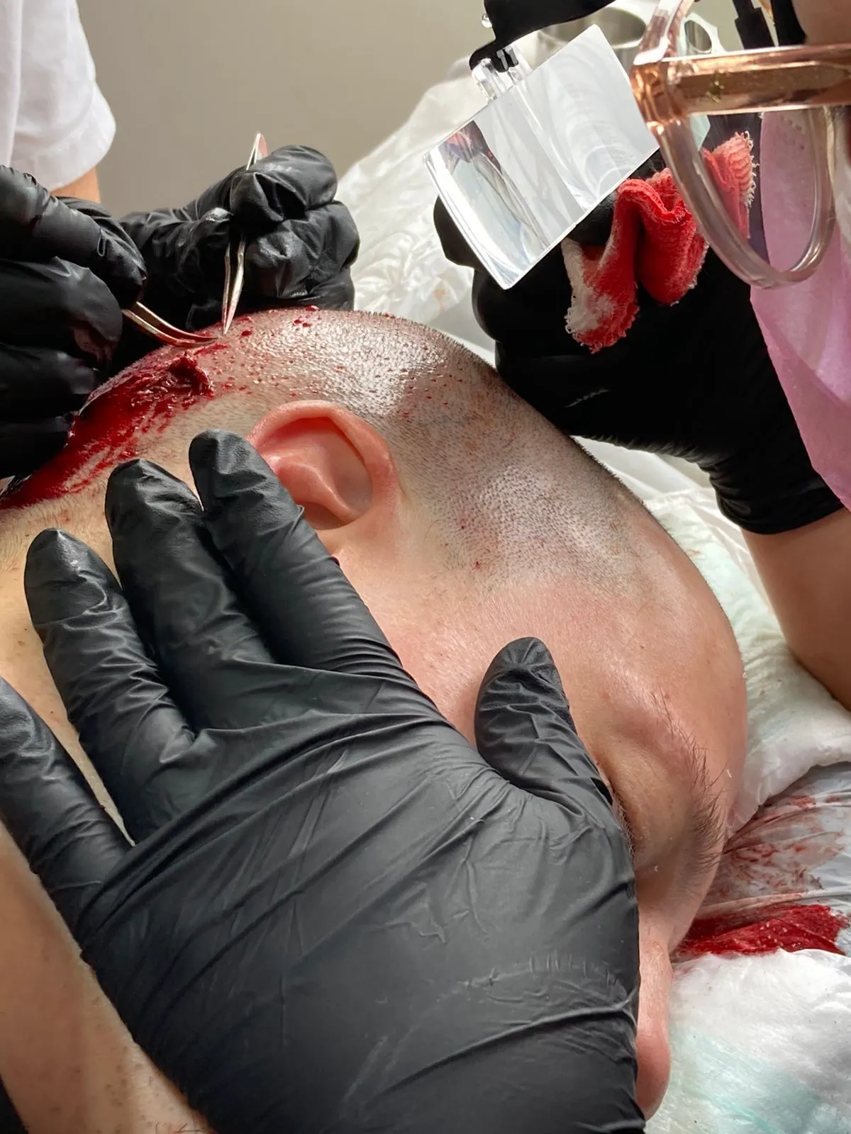 Clínica Quantum team during an FUE hair transplant