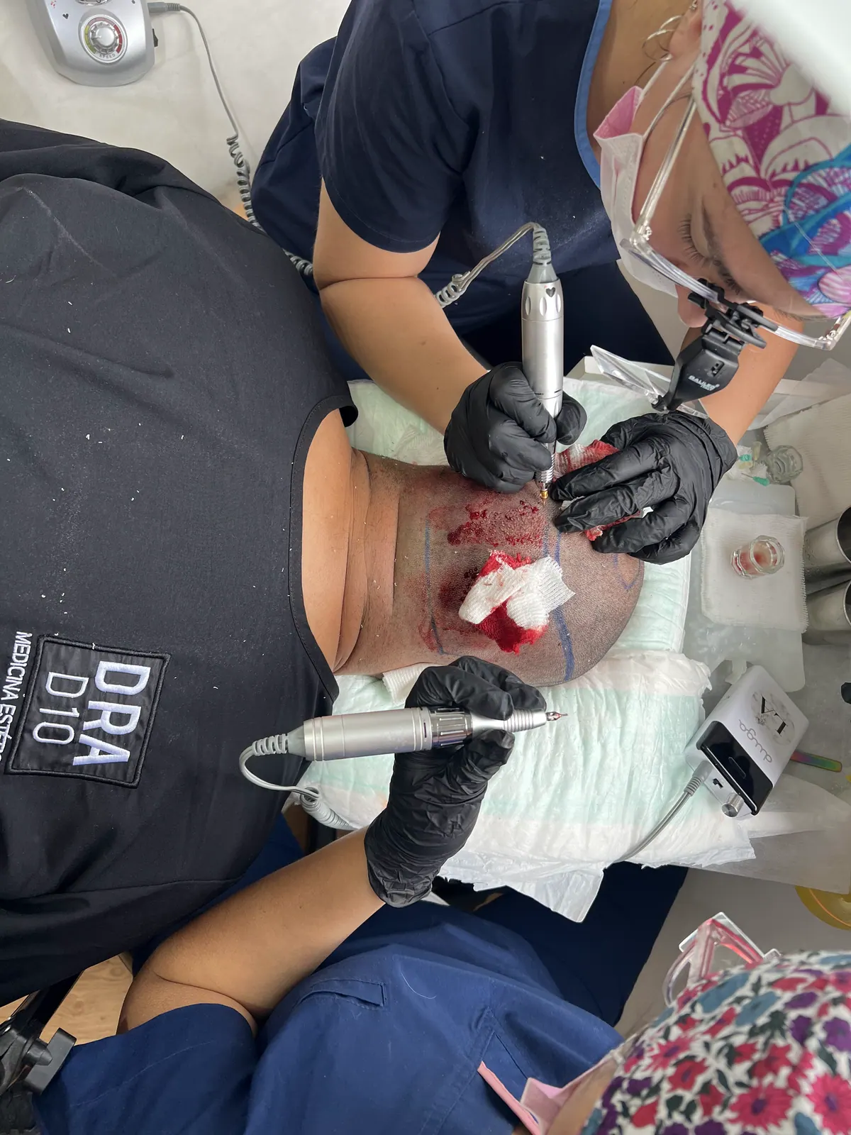 Clínica Quantum team during an FUE hair transplant