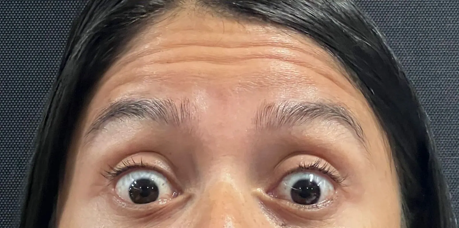 Botulinum toxin · forehead and frown lines: before