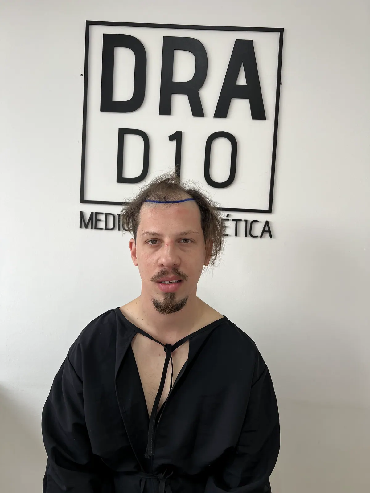 FUE hair transplant · front: before