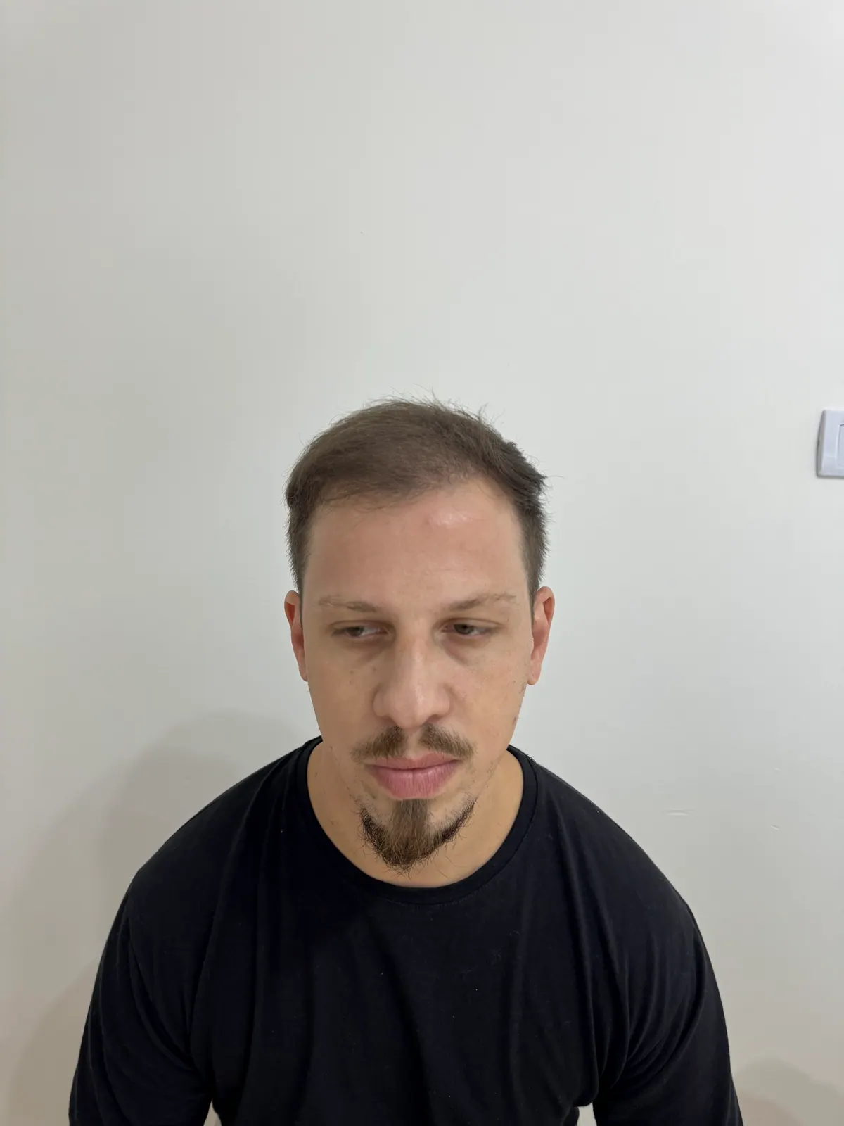 FUE hair transplant · front: after
