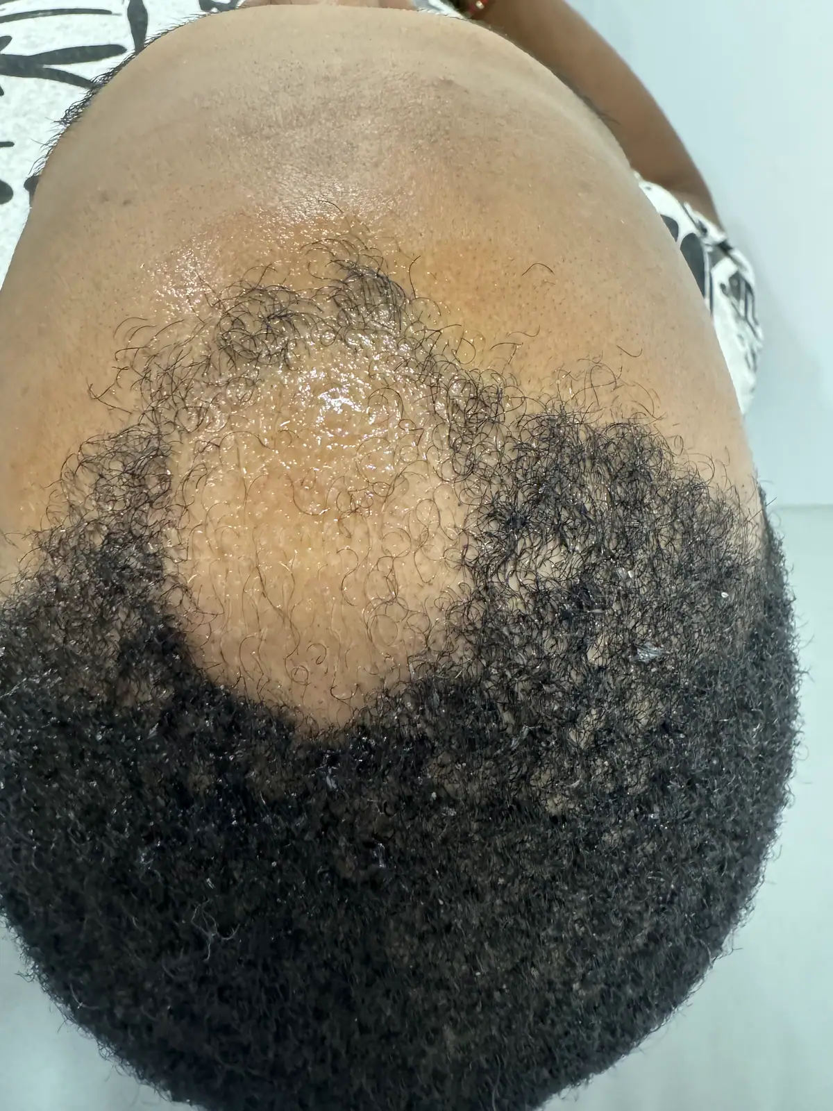 Alopecia areata · progress: before
