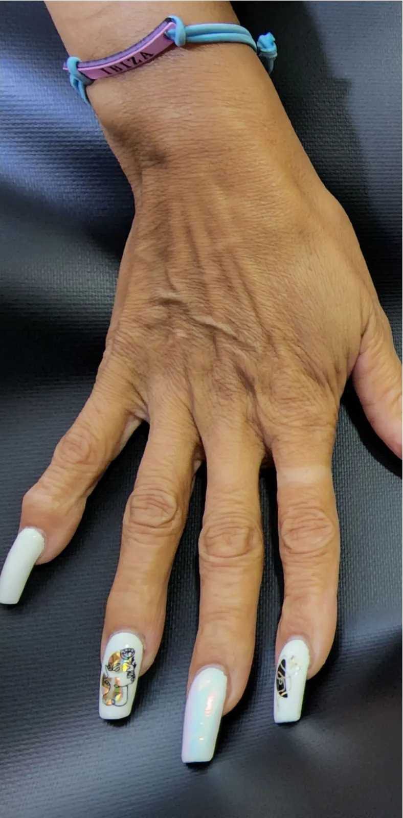 Hand rejuvenation: before