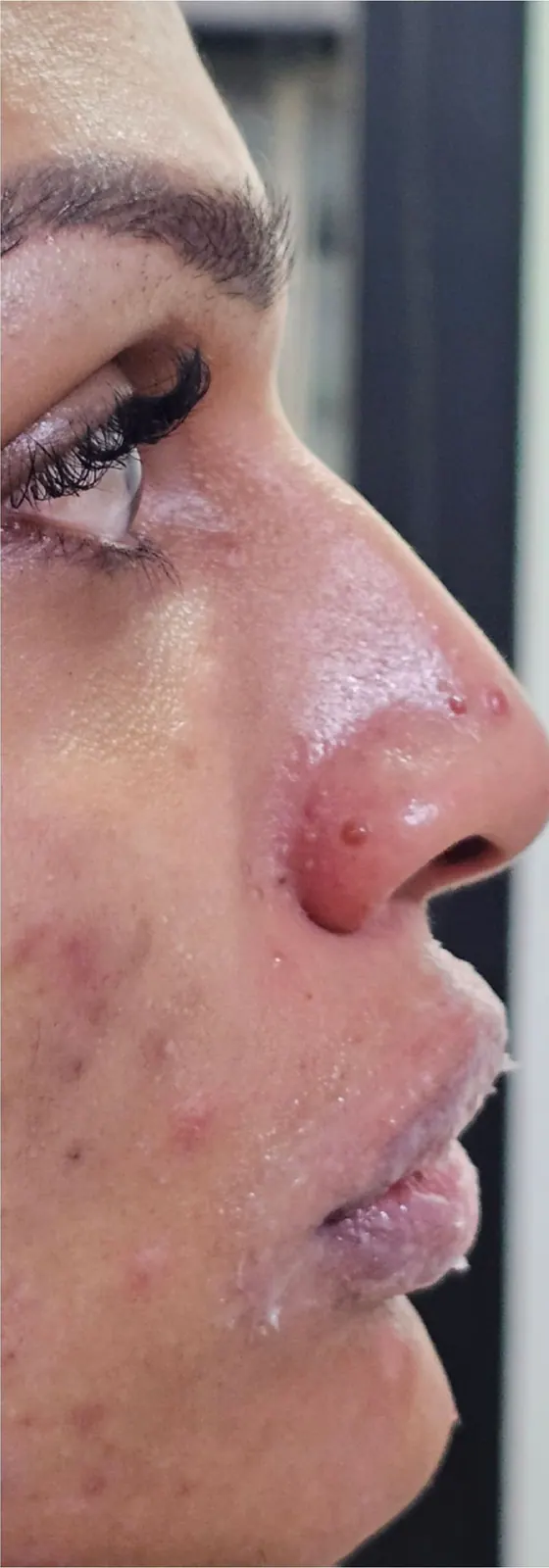 Acne-prone skin · profile: before