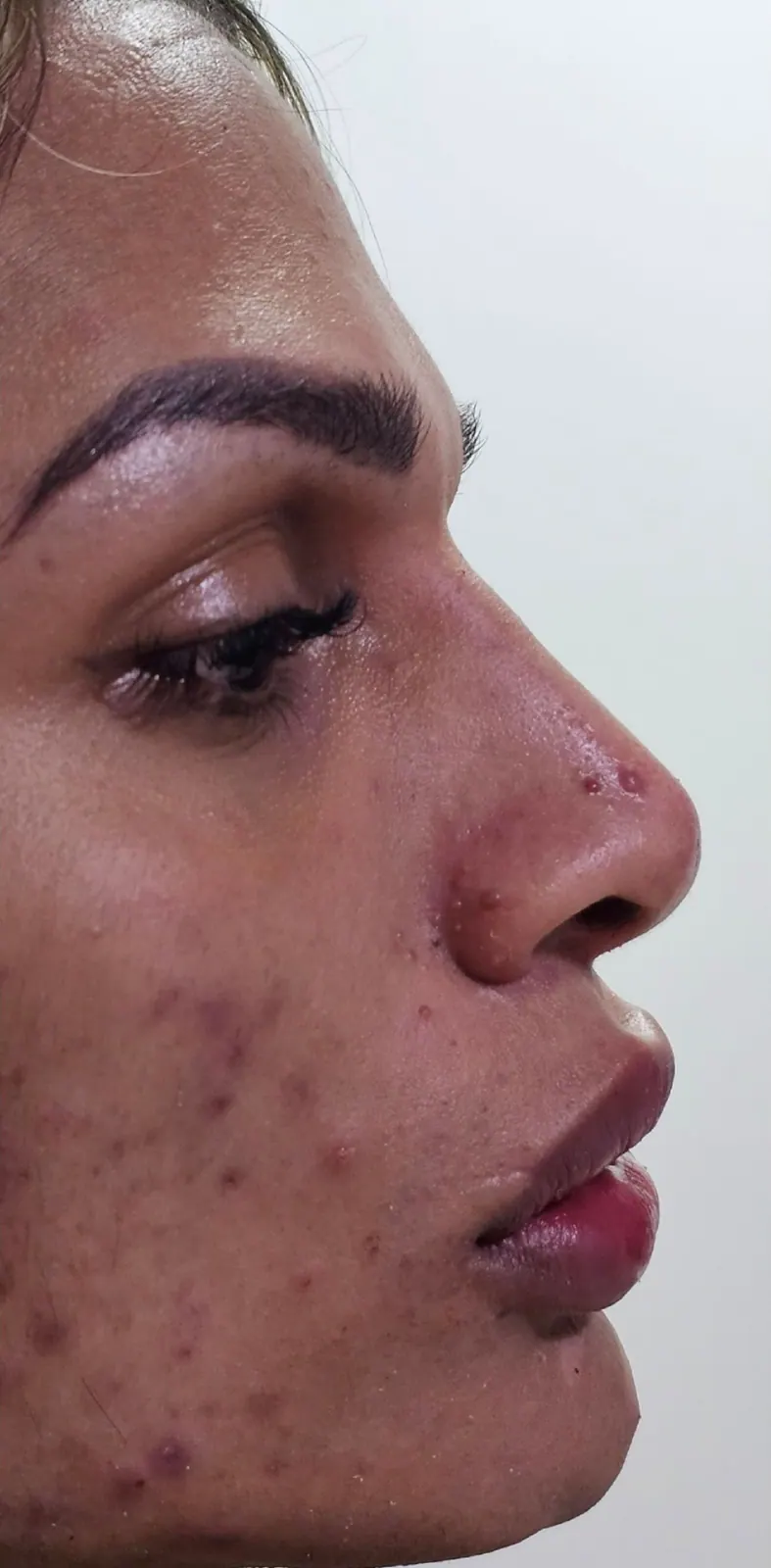 Acne-prone skin · profile: after