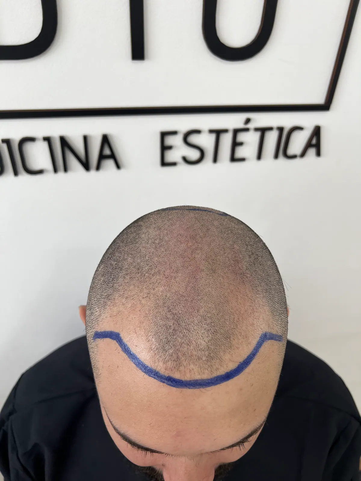Diseño de la línea capilar antes de un implante
