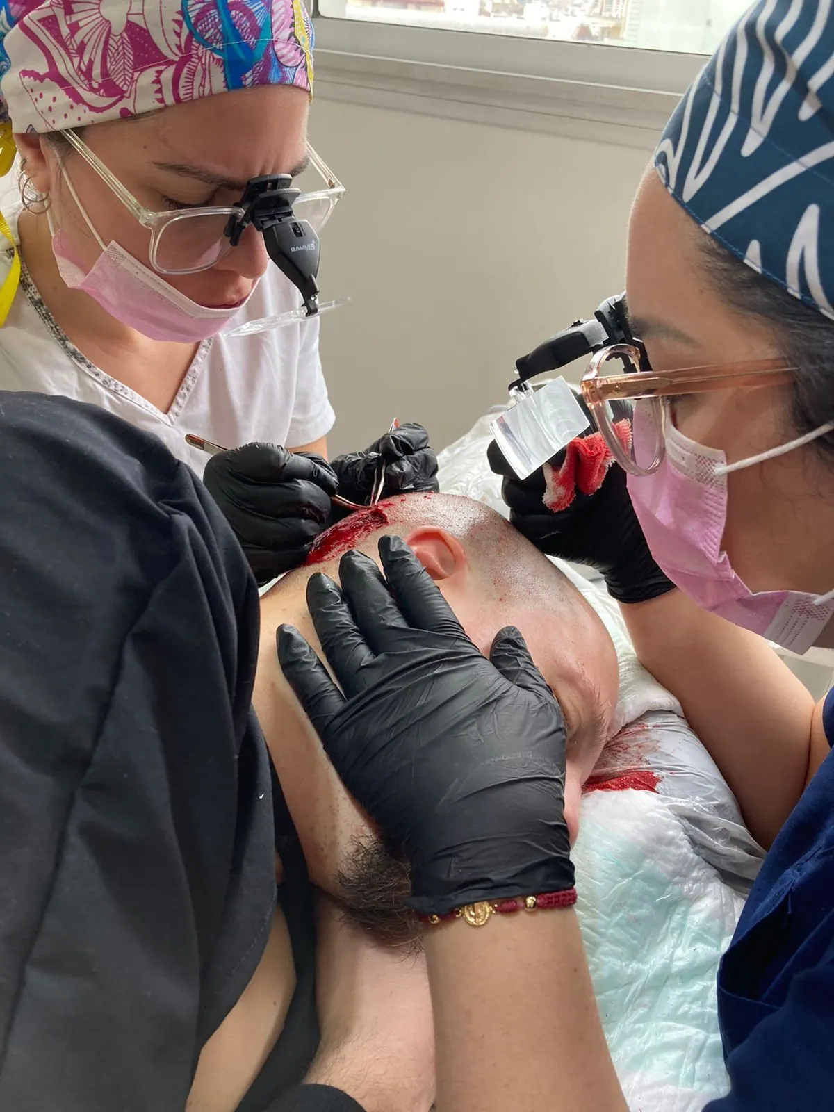 Equipo de Clínica Quantum durante un implante capilar FUE