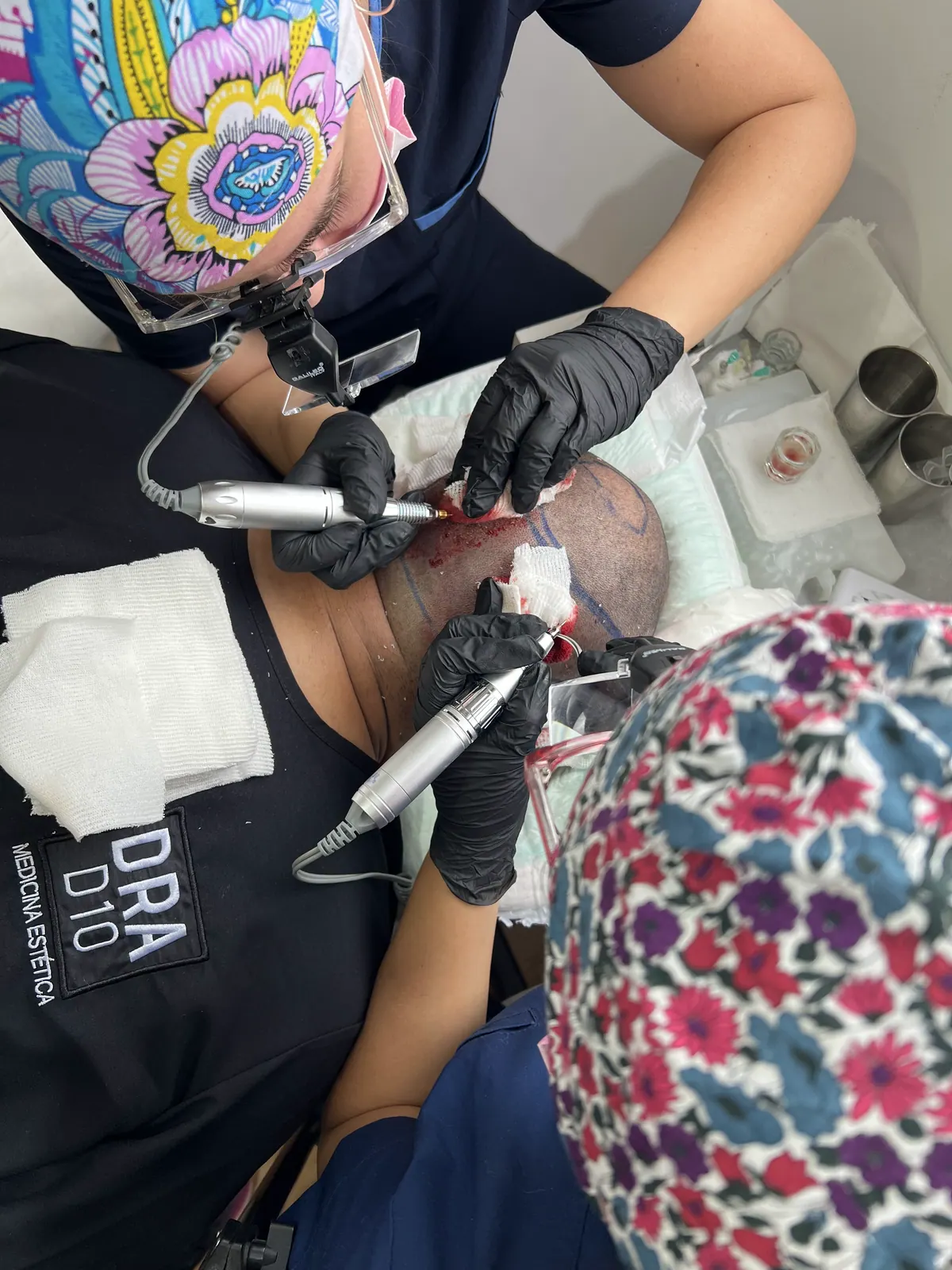 Equipo de Clínica Quantum durante un implante capilar FUE
