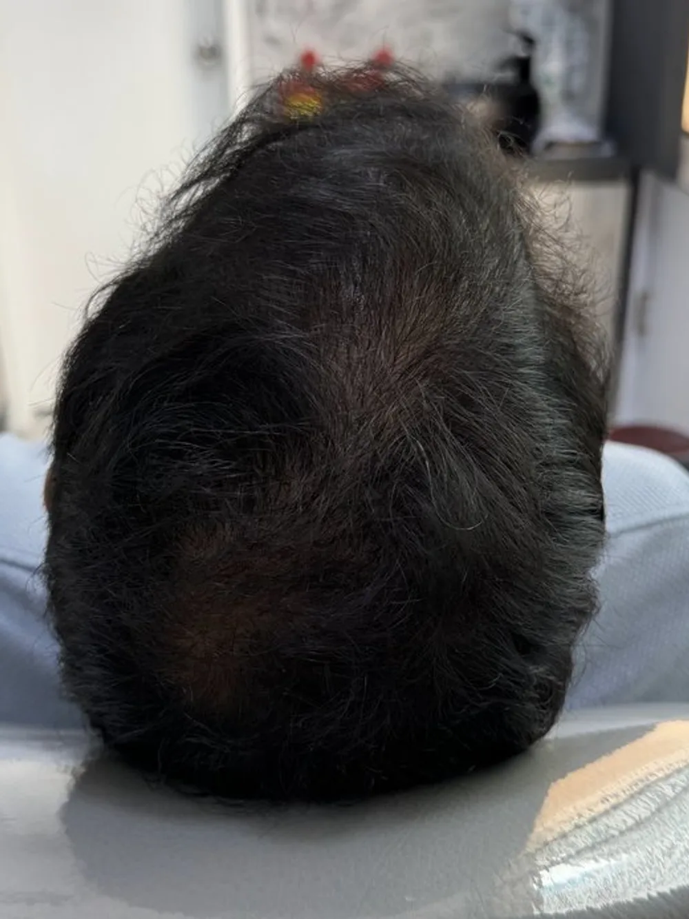 Menos cuero cabelludo visible: resultado