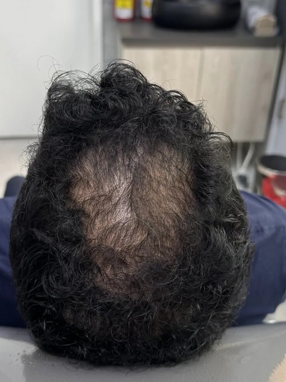 From a thin spot at the crown to full hair: before
