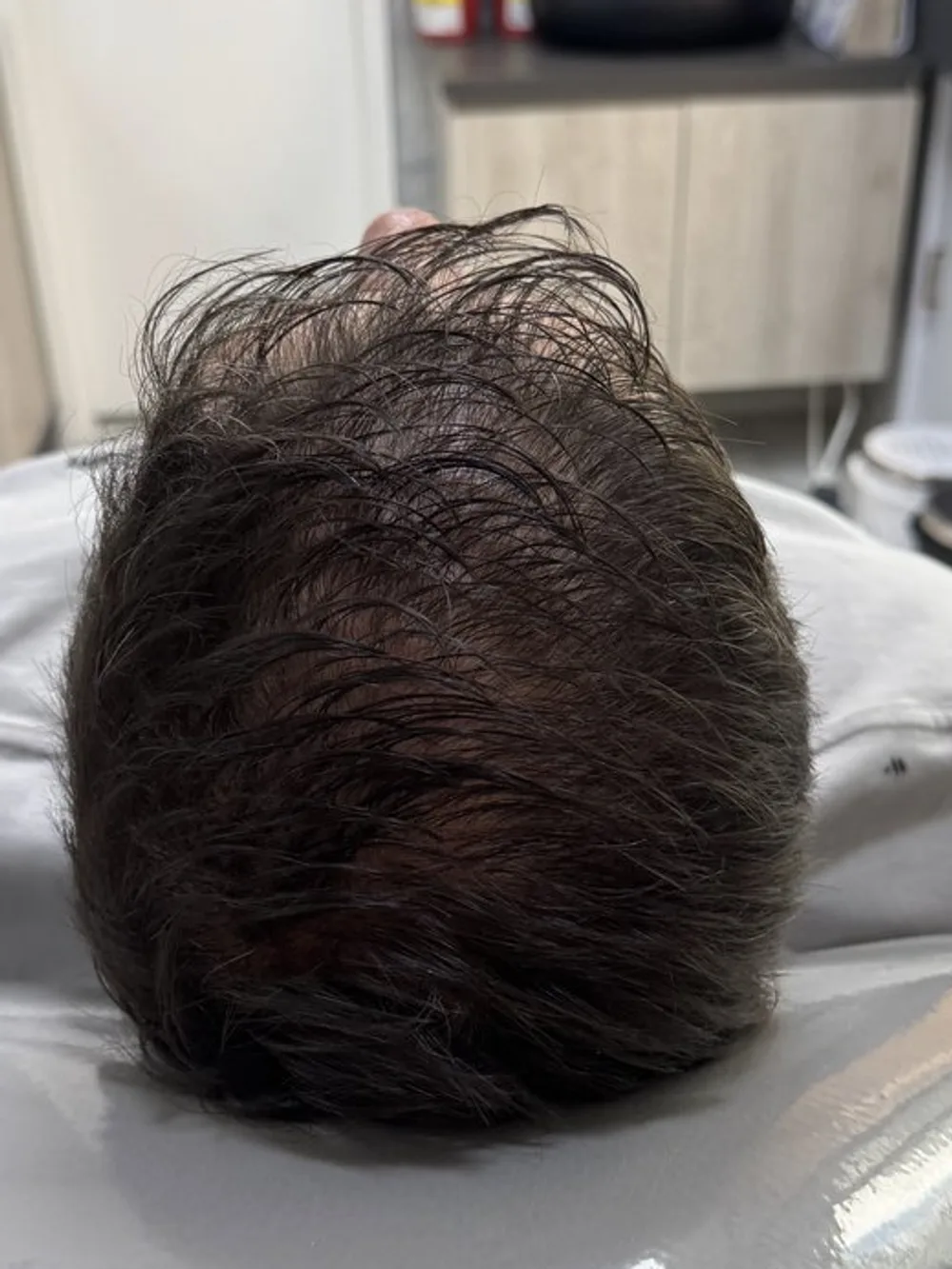 Más cabello y menos brillo del cuero cabelludo: resultado