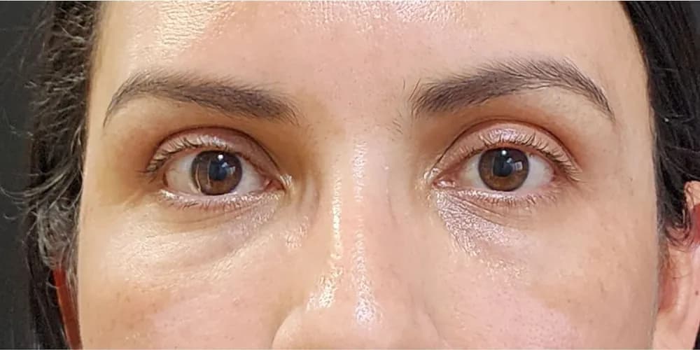 Zona de ojeras más uniforme: resultado