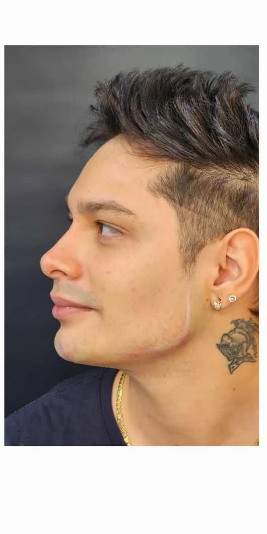 Jawline definition: result