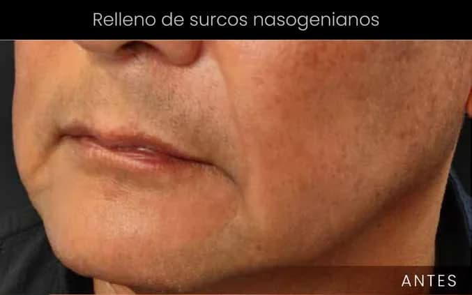 Suavizado de surcos nasogenianos: antes
