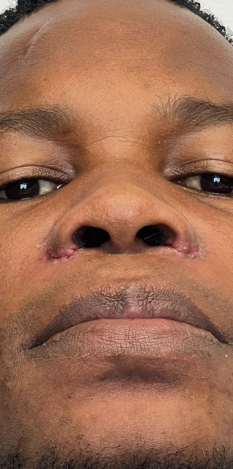 Alectomía · base nasal: resultado