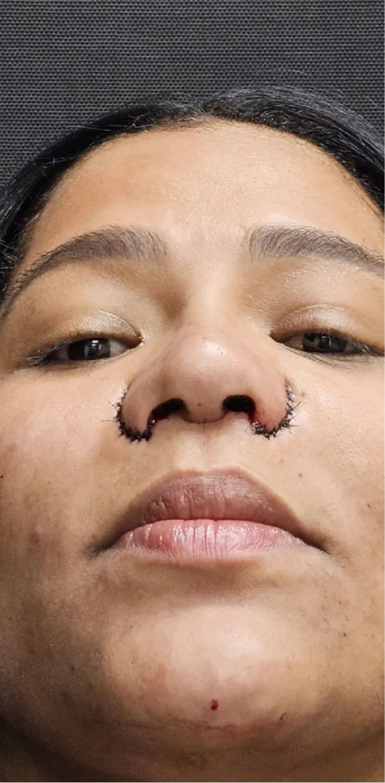 Alectomía · base nasal · postoperatorio inmediato: resultado