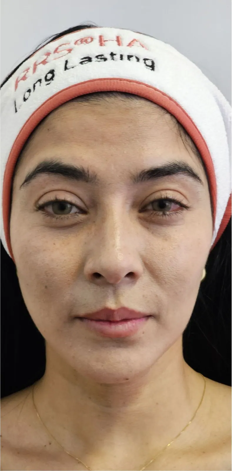 Rejuvenecimiento facial · frente: antes