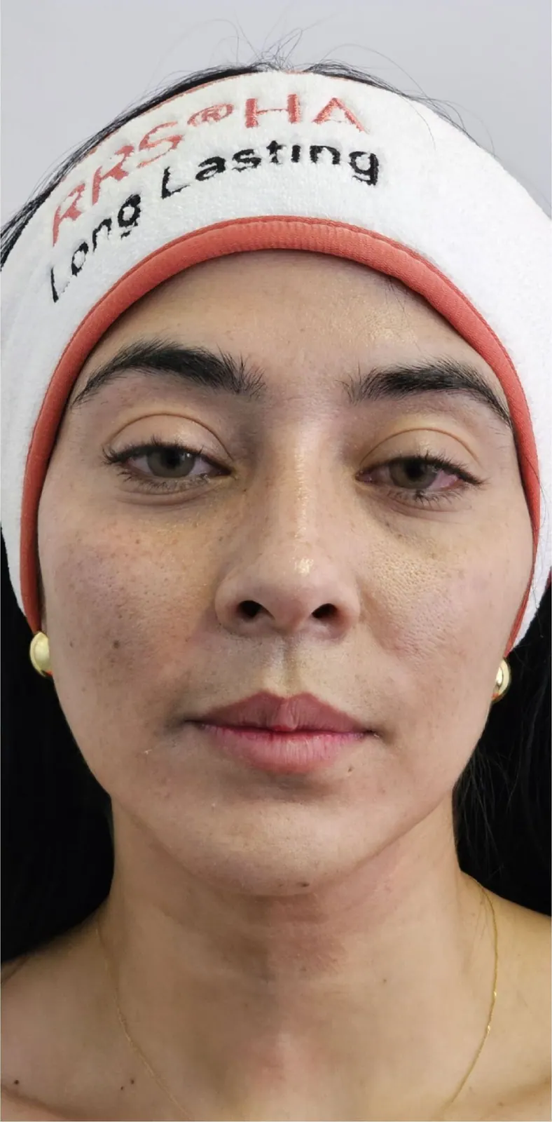 Rejuvenecimiento facial · frente: después