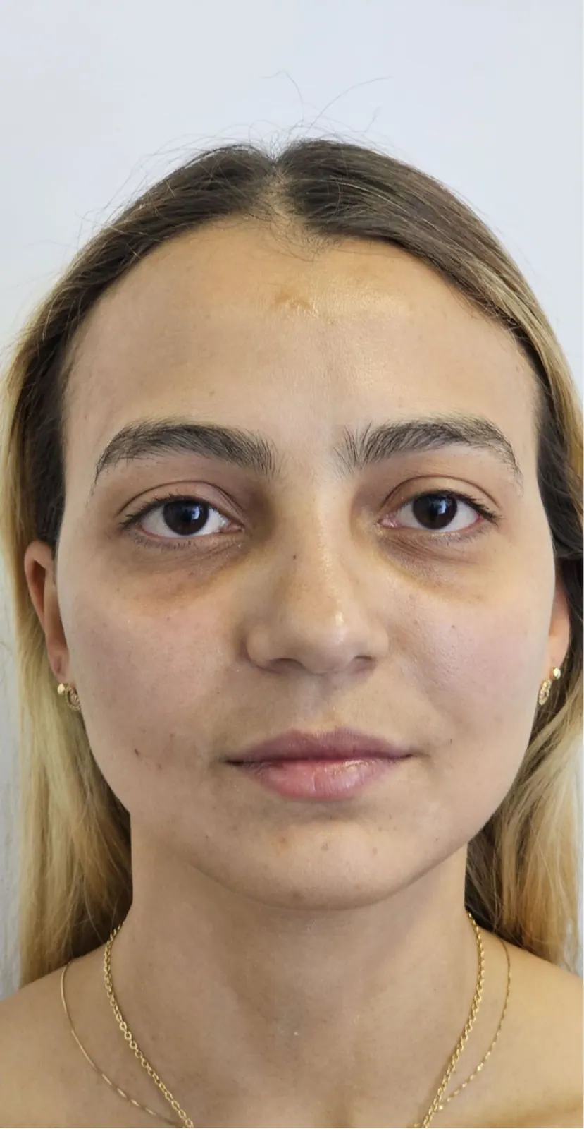 Rejuvenecimiento facial · frente: resultado