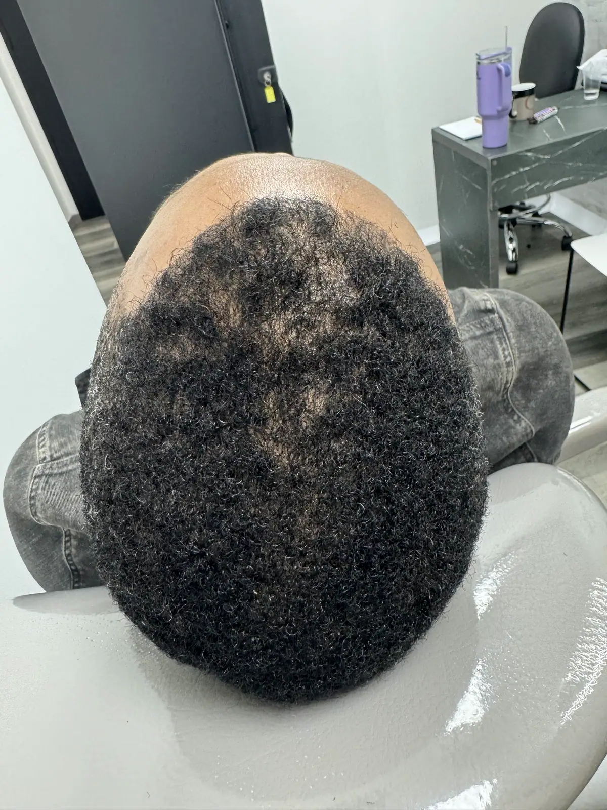 Alopecia areata · evolución: después