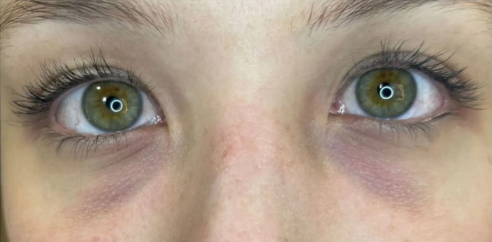Ojeras · antes y después: antes