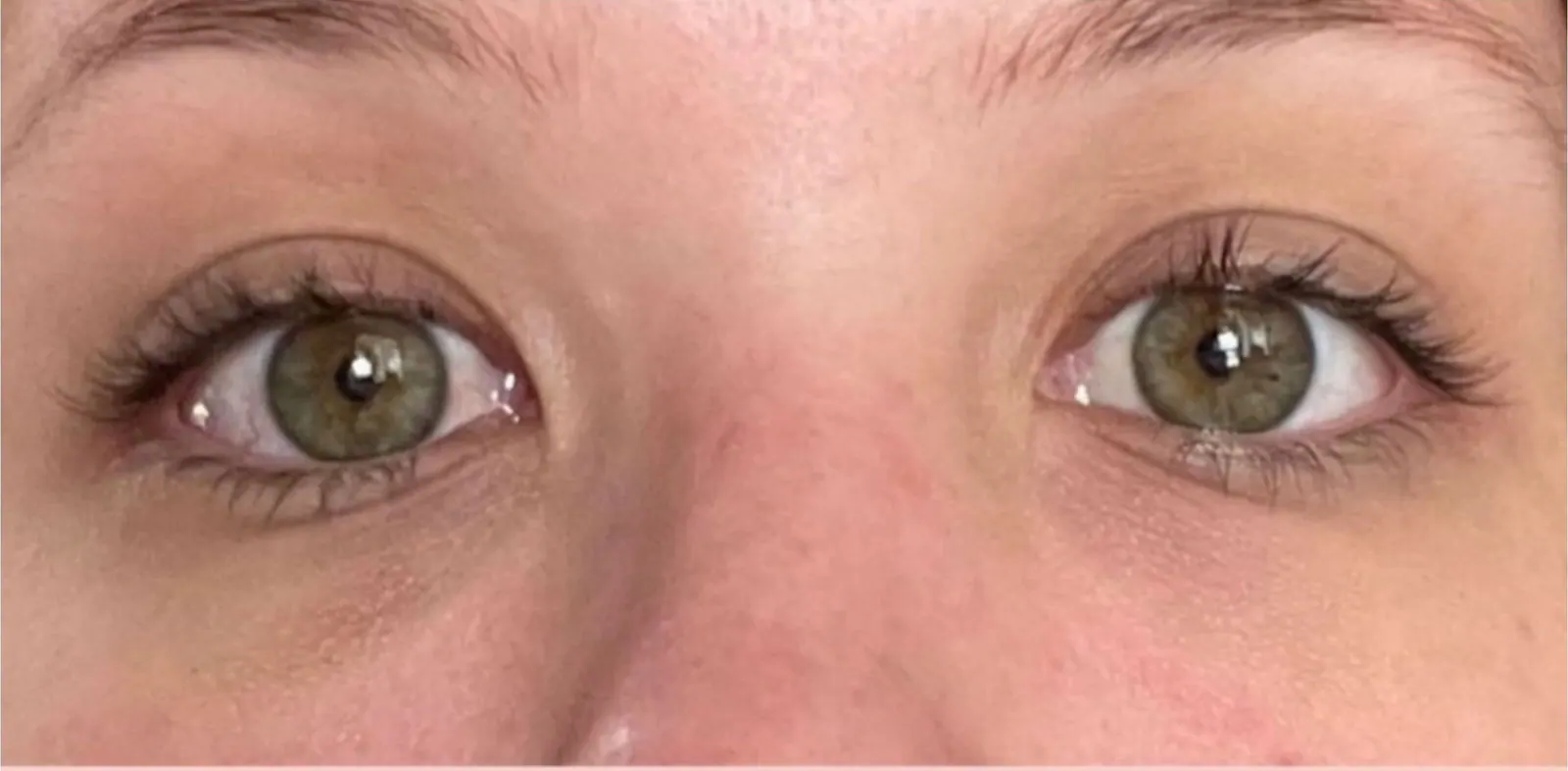 Ojeras · antes y después: después