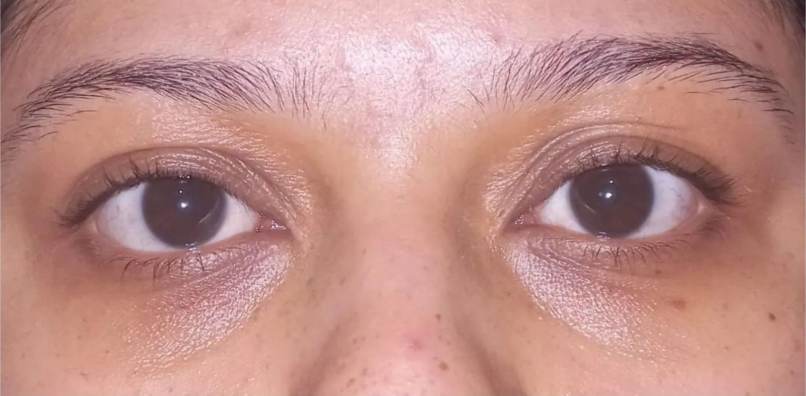 Ojeras · antes y después: resultado