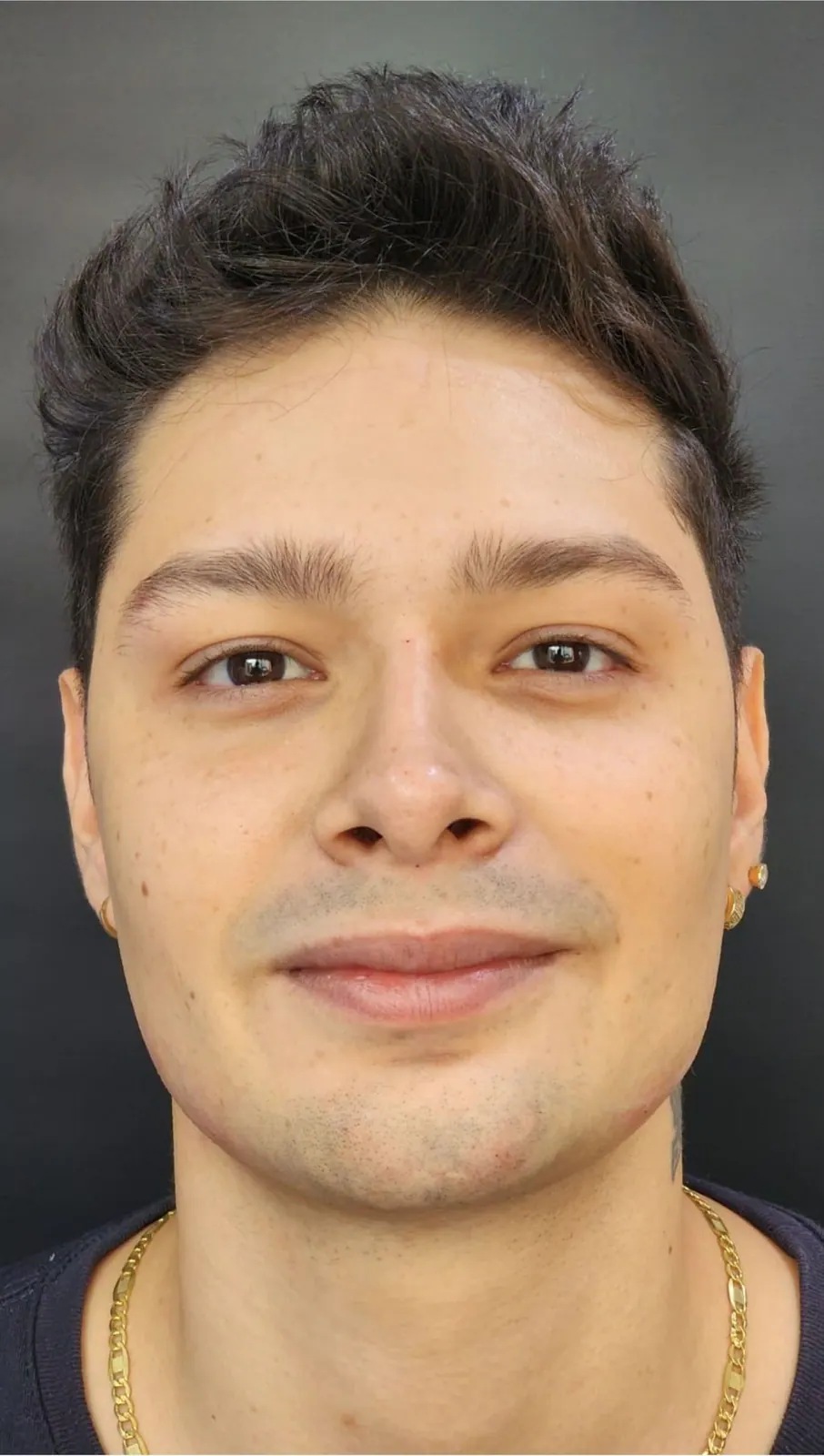 Contorno facial masculino · frente: después