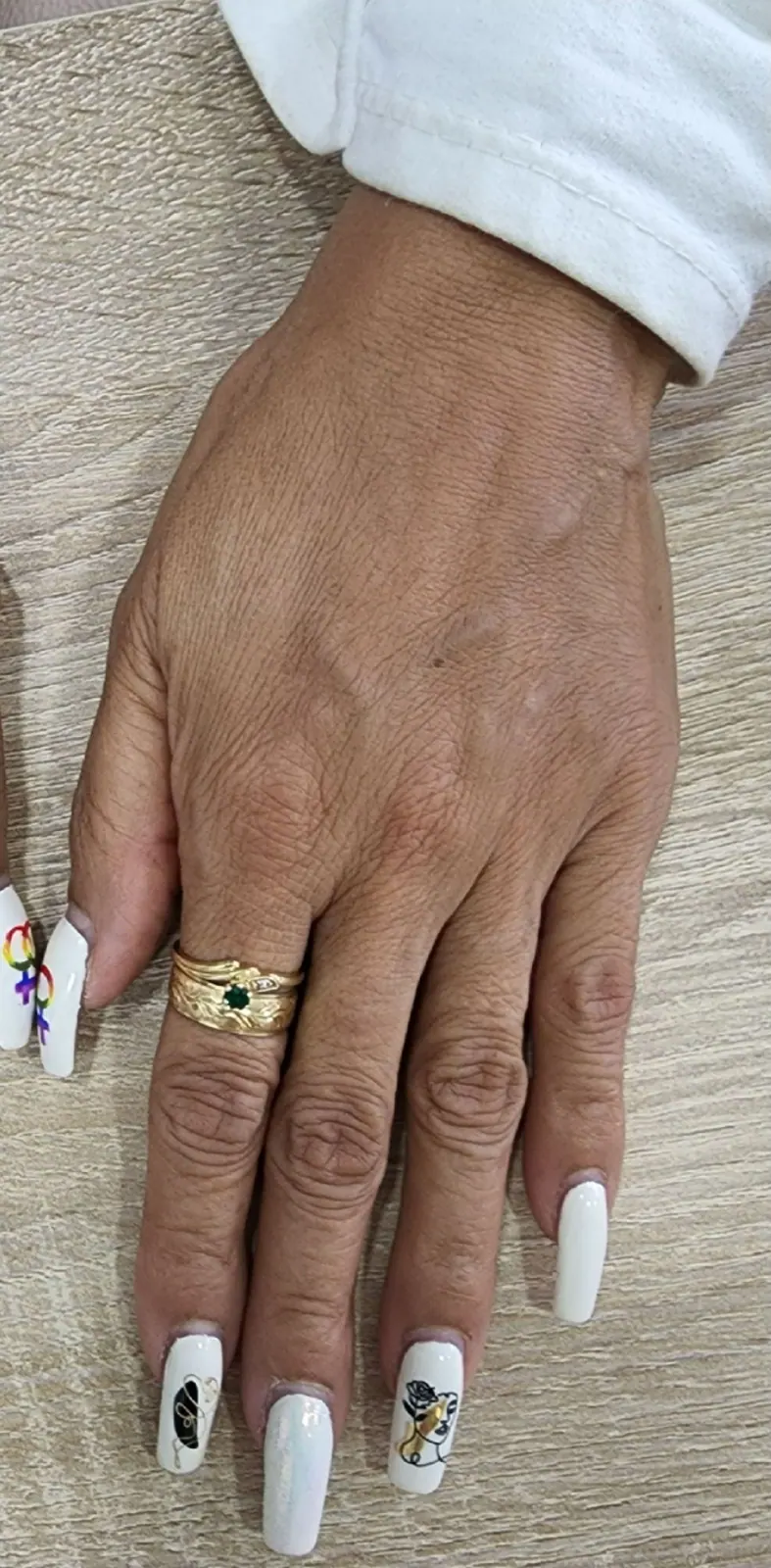 Hand rejuvenation: result