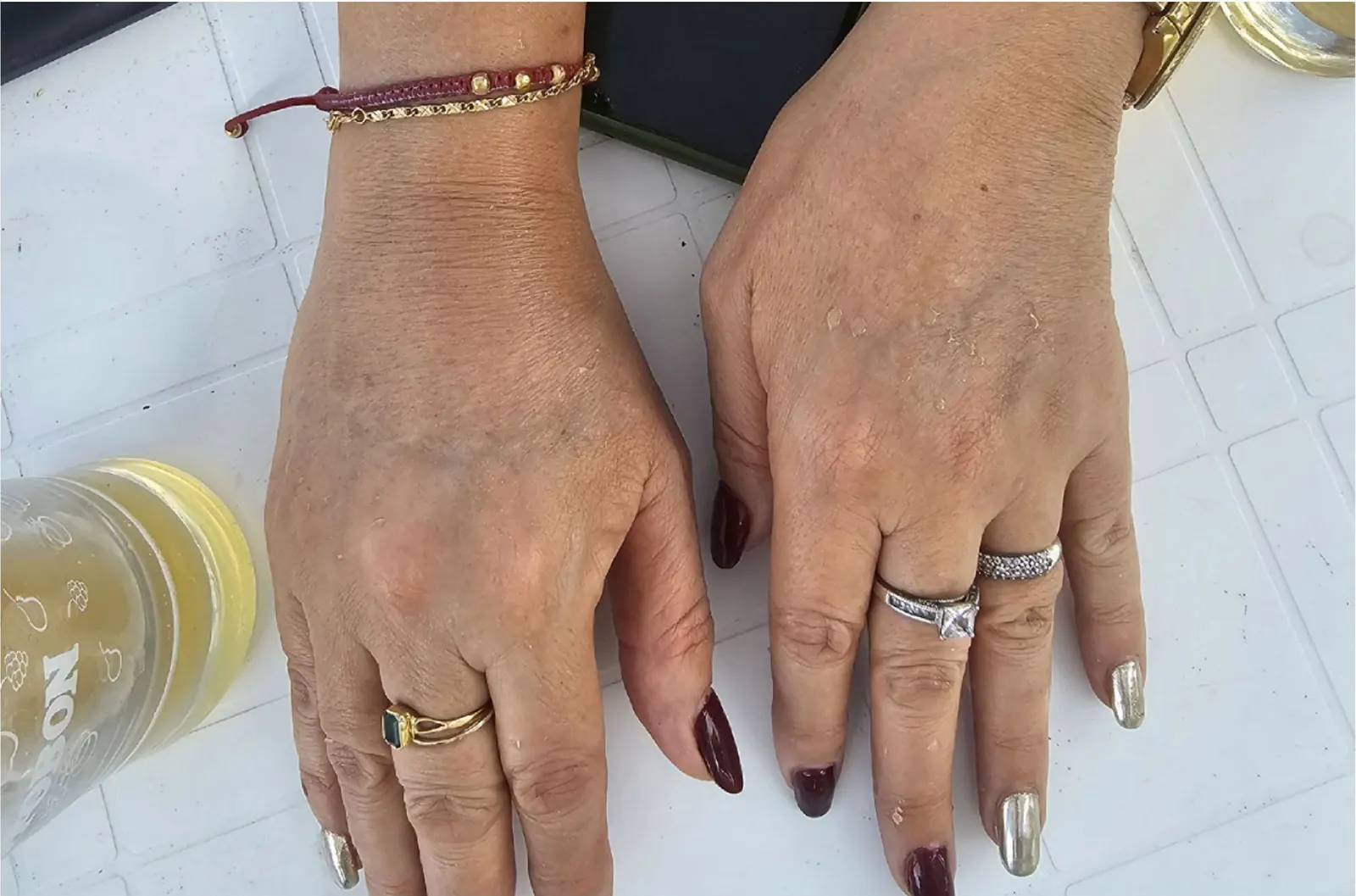 Hand rejuvenation: result