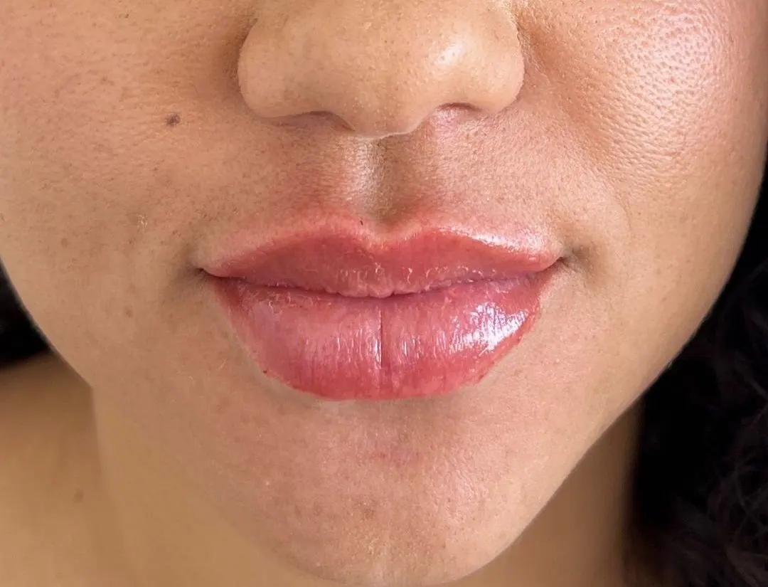 Relleno de labios con ácido hialurónico: resultado