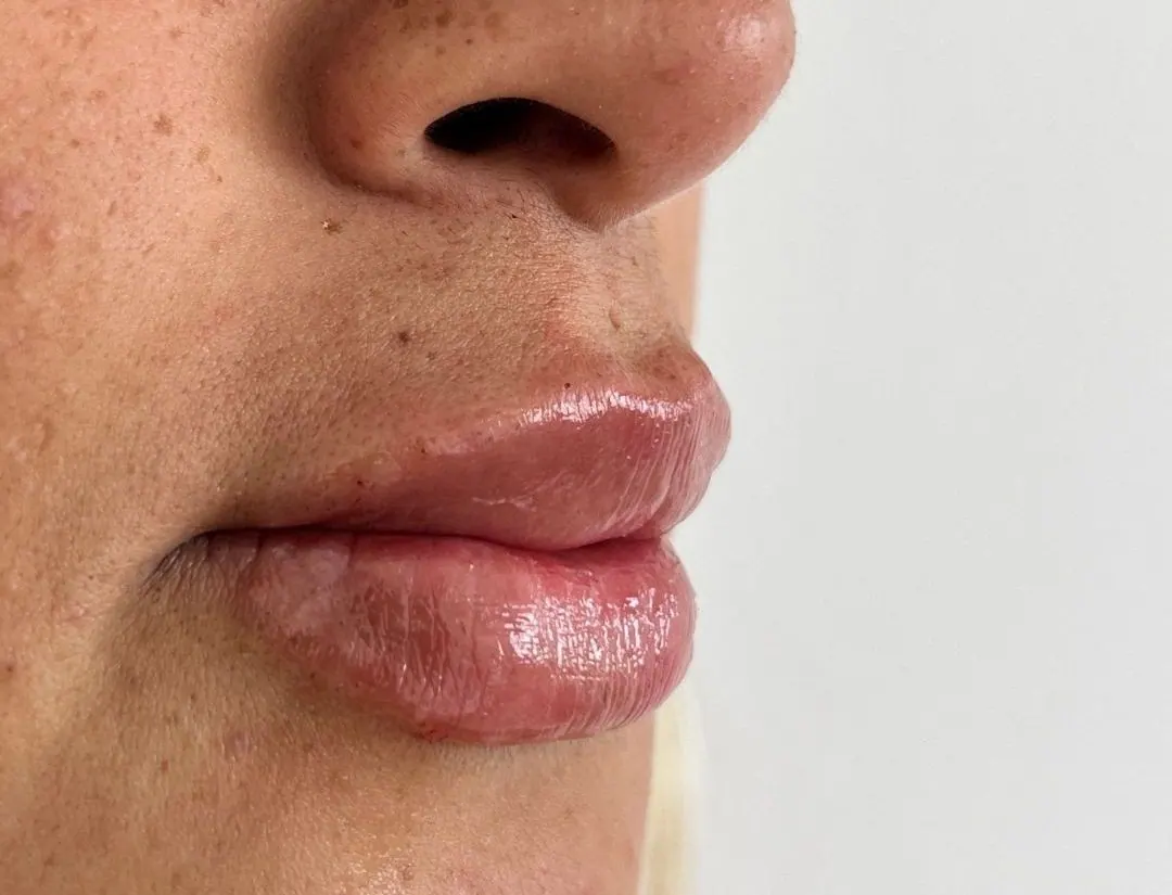 Relleno de labios con ácido hialurónico: resultado