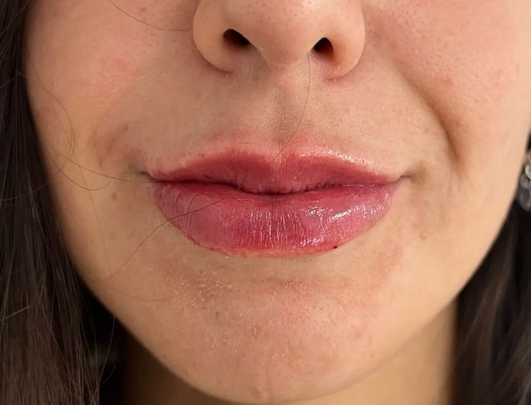 Relleno de labios con ácido hialurónico: resultado