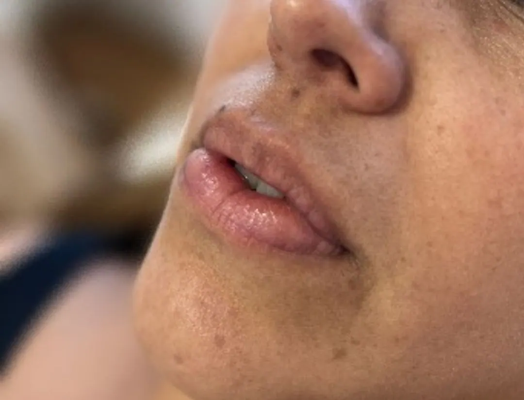 Relleno de labios con ácido hialurónico: Antes