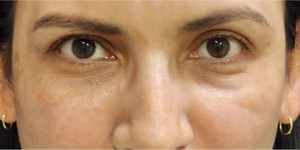 Ojeras · antes y después: Antes