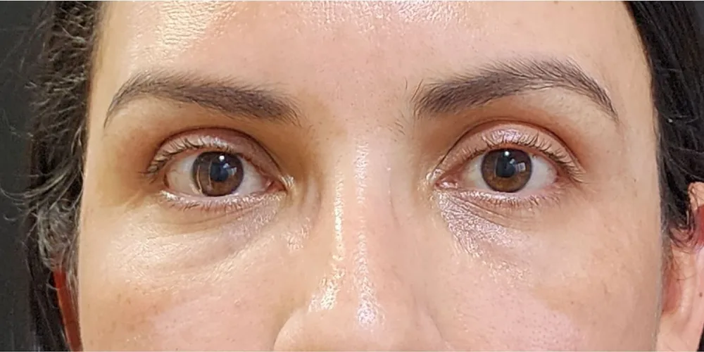 Ojeras · antes y después: Después