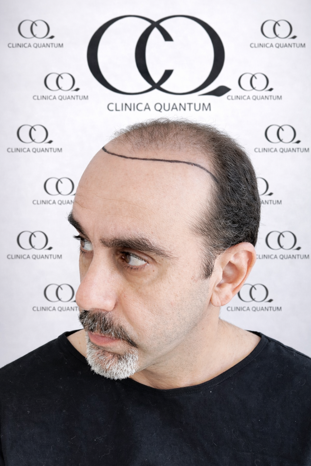 Vista de perfil derecho antes del trasplante capilar FUE