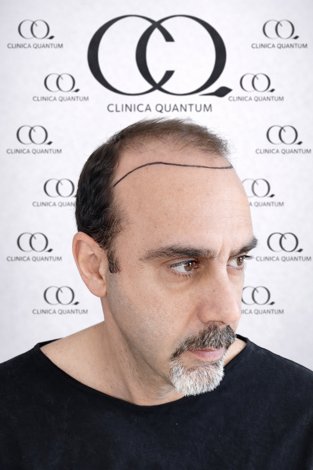 Vista de perfil izquierdo antes del trasplante capilar FUE