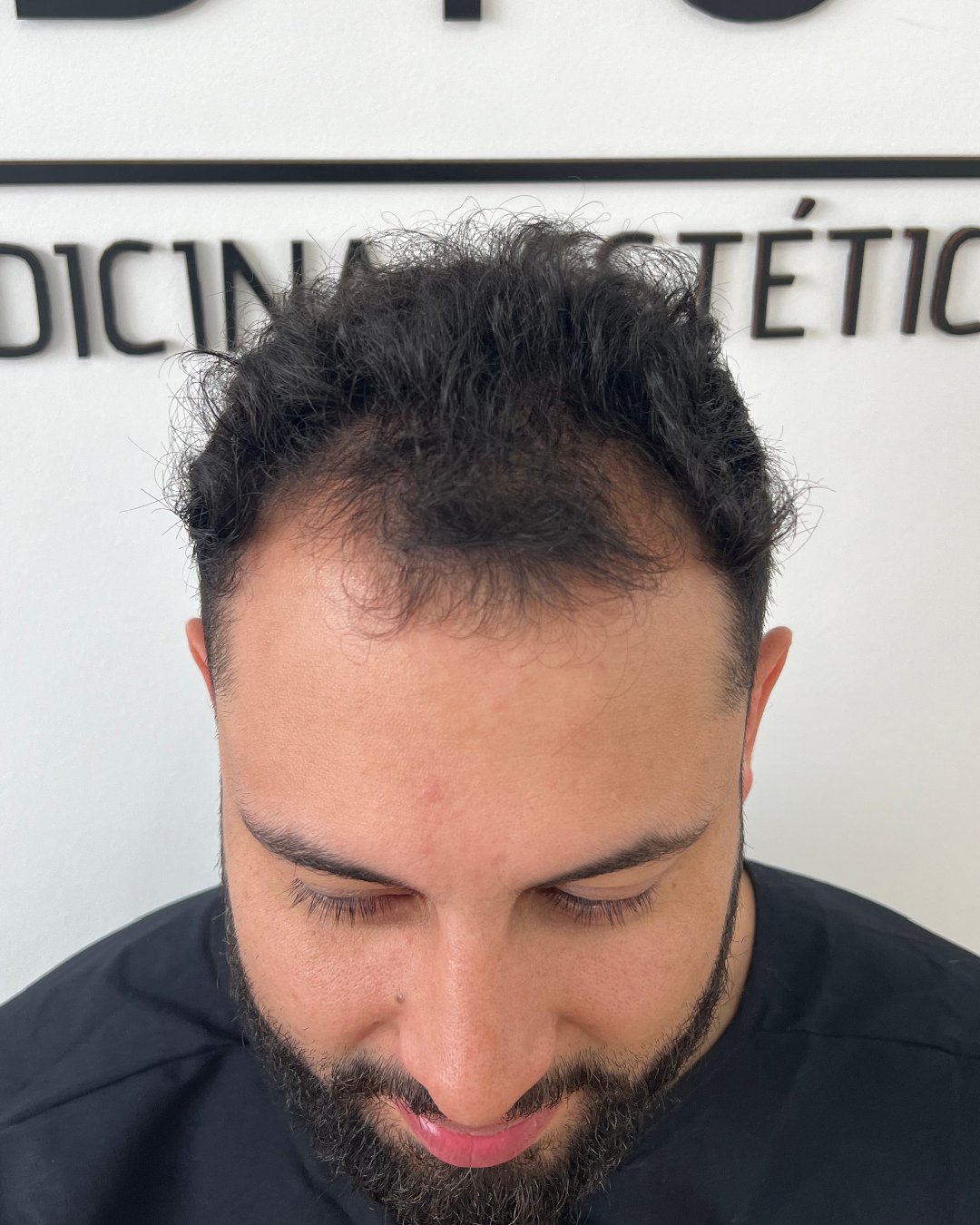 Paciente antes del trasplante capilar FUE - Caso 02